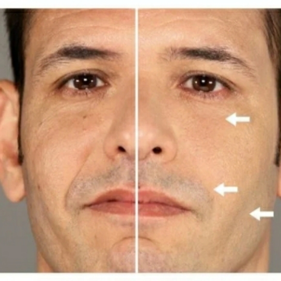 PREORDER ONLY Anti-Wrinkle/Crow's Feet/Sagging Skin - Picture 3 of 4